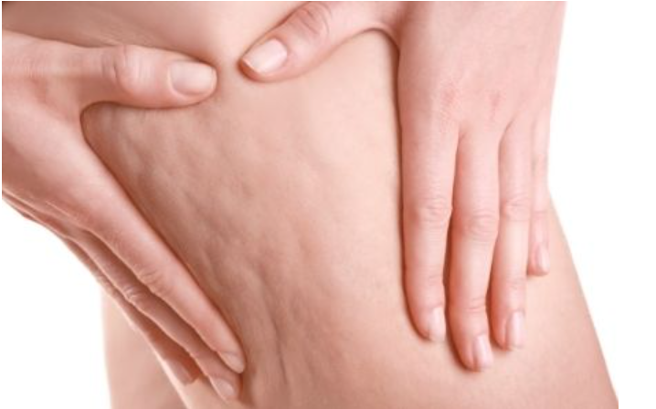 Exemple de cellulite aqueuse sur les cuisses et les jambes