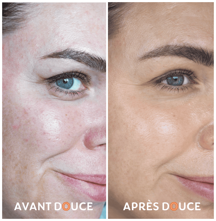 skin-avant-apres-1