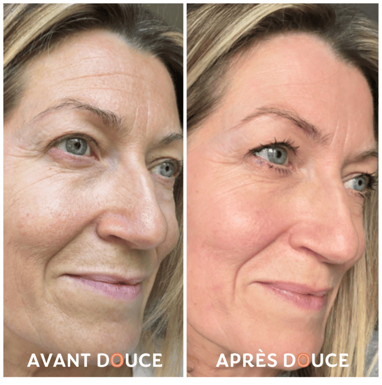 skin-avant-apres-2