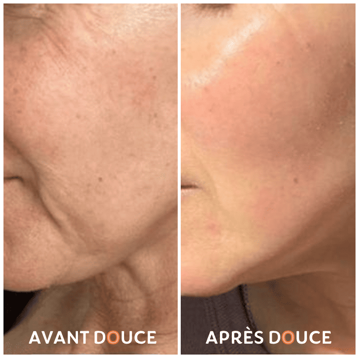 skin-avant-apres-3