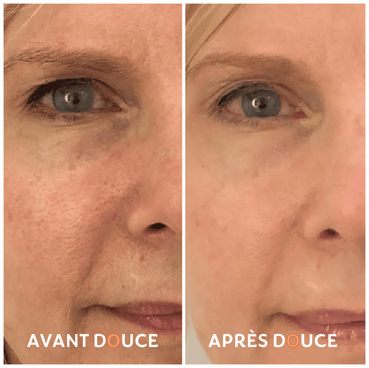 skin-avant-apres-4